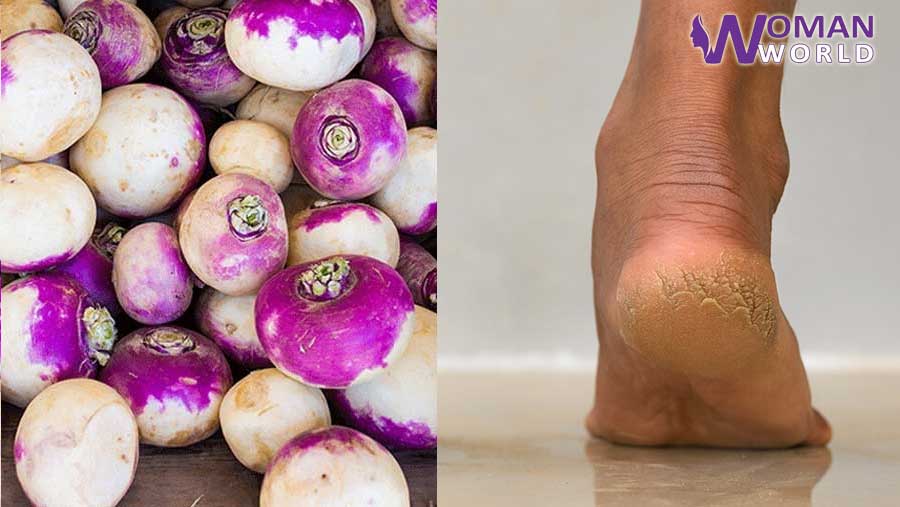 سردیوں میں ایڑیاں بری طرح پھٹ جاتی ہیں اسے ٹھیک کیسے کریں؟ جانیں گھر بیٹھے پھٹی ایڑیوں کو شلجم سے ملائم بنانے کا آسان طریقہ